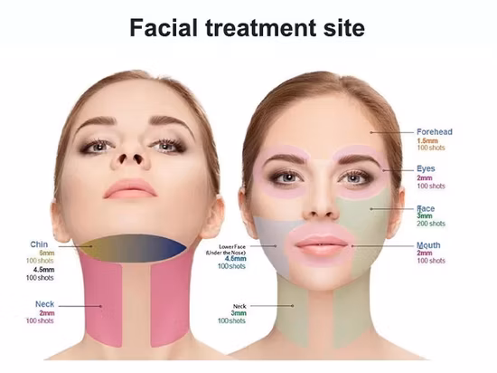 4D Hifu-Maschine 20000 Schüsse Facelift-Körperschlankheit