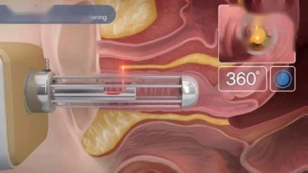 Metall-RF-Röhre, Entfernung von Dehnungsstreifen, Vaginalstraffung, fraktionierter CO2-Laser, fraktionierter CO2-Laser, Vaginalstraffung, Hautverjüngung, fraktionierter CO2-Laser